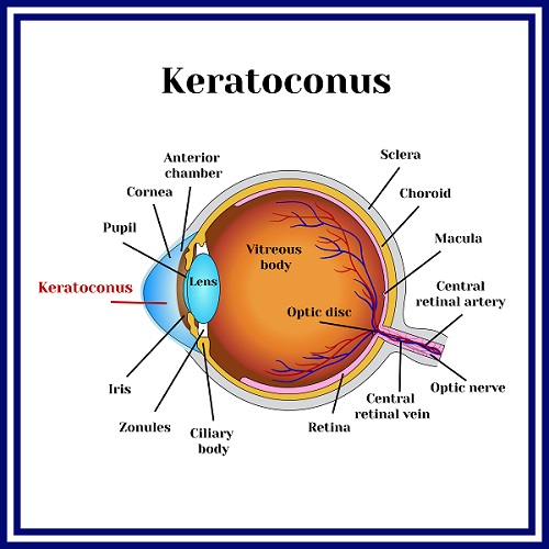 Keratokonus