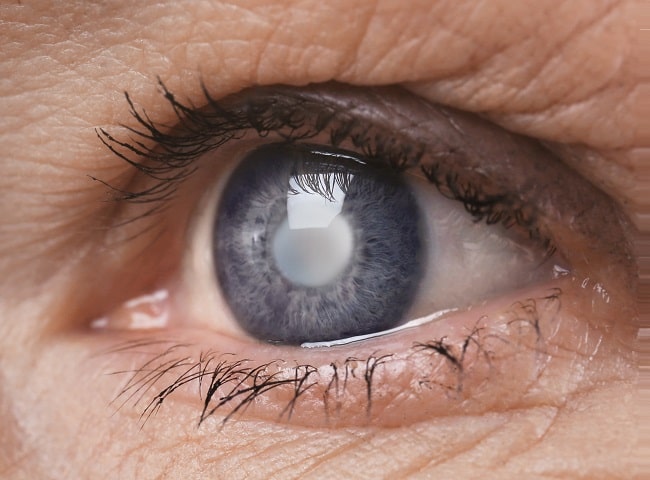cataract-eye-left